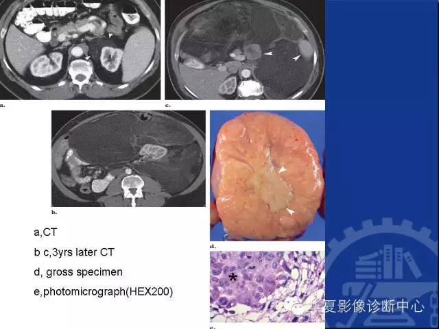 腹膜后含有脂肪成分病变 影像和病理对照