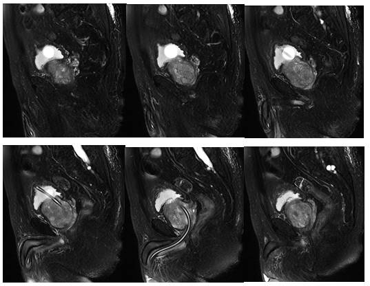 【病例学习】前列腺增生一例MR影像表现 【病例学习】前列腺增生一例MR影像表现
