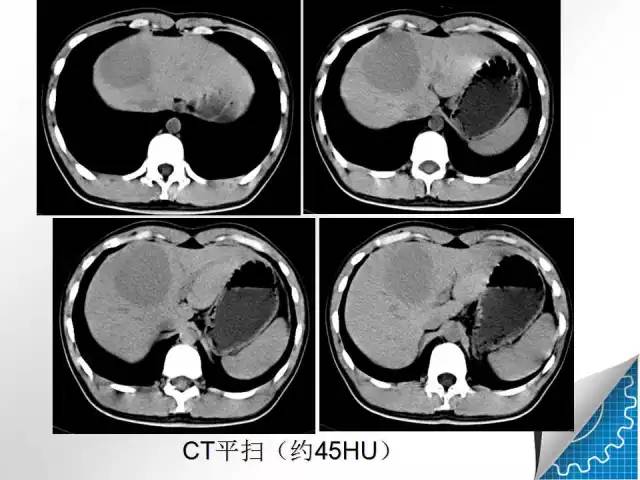 【病例学习】肝脏原发性恶性淋巴瘤一例CT MR影像表现