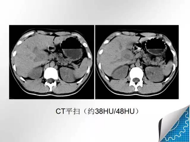 【病例学习】肝脏原发性恶性淋巴瘤一例CT MR影像表现