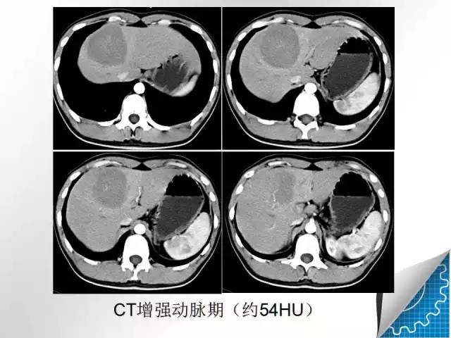 【病例学习】肝脏原发性恶性淋巴瘤一例CT MR影像表现