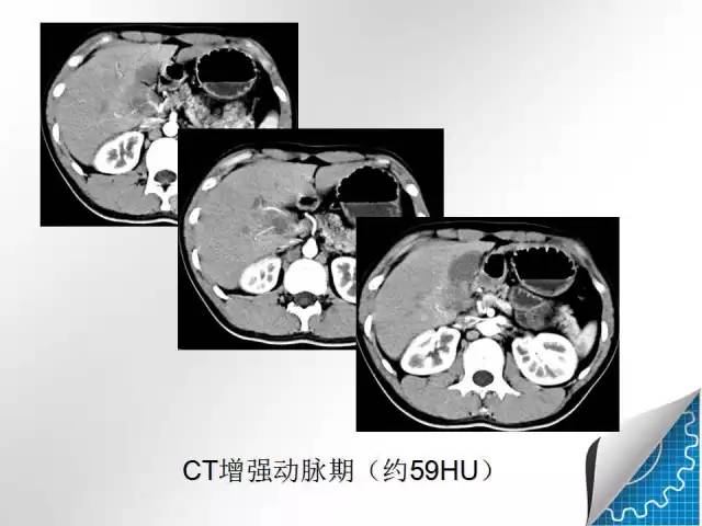 【病例学习】肝脏原发性恶性淋巴瘤一例CT MR影像表现