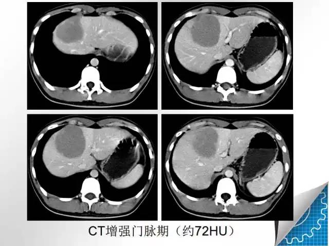【病例学习】肝脏原发性恶性淋巴瘤一例CT MR影像表现