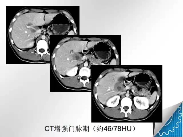 【病例学习】肝脏原发性恶性淋巴瘤一例CT MR影像表现