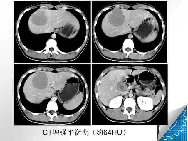 【病例学习】肝脏原发性恶性淋巴瘤一例CT MR影像表现