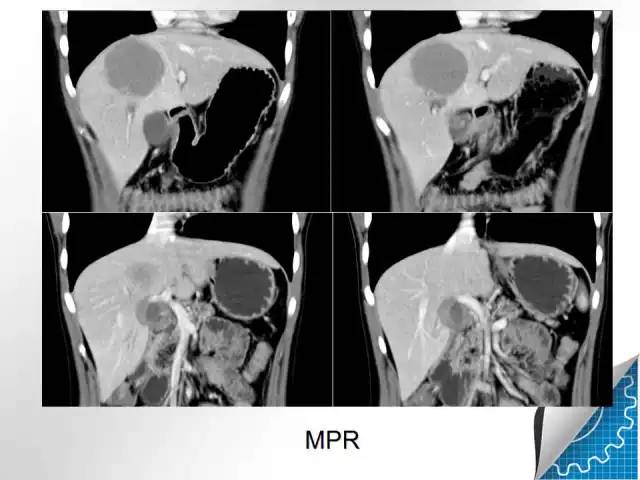 【病例学习】肝脏原发性恶性淋巴瘤一例CT MR影像表现