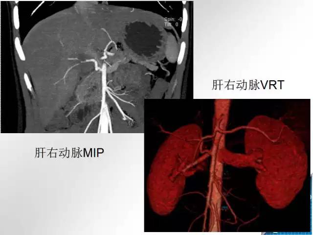 【病例学习】肝脏原发性恶性淋巴瘤一例CT MR影像表现