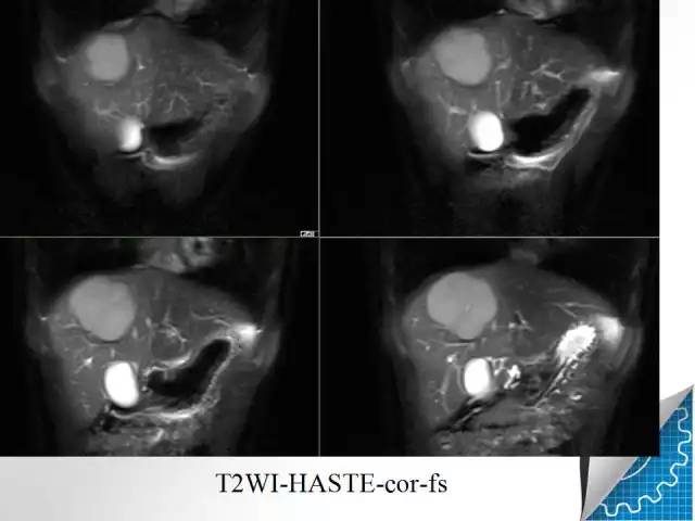 【病例学习】肝脏原发性恶性淋巴瘤一例CT MR影像表现