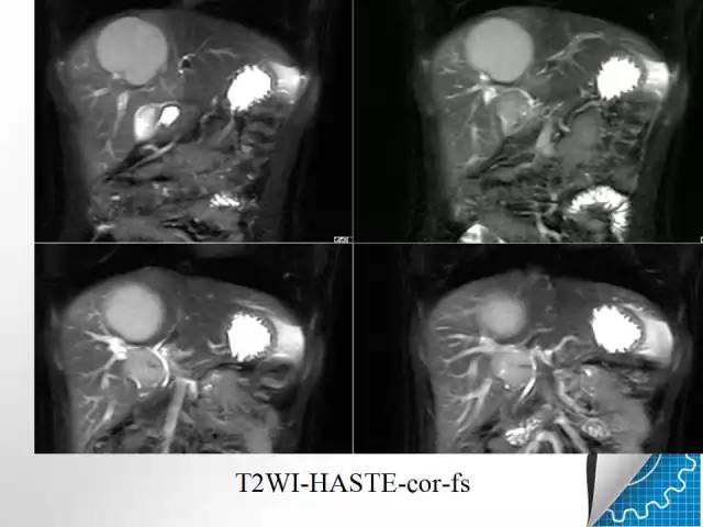 【病例学习】肝脏原发性恶性淋巴瘤一例CT MR影像表现
