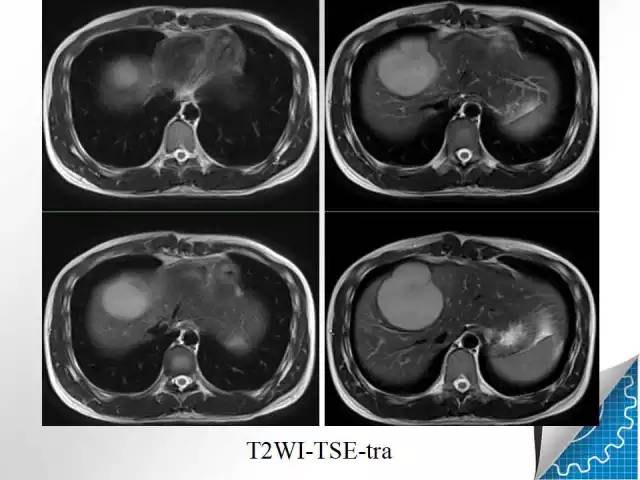 【病例学习】肝脏原发性恶性淋巴瘤一例CT MR影像表现