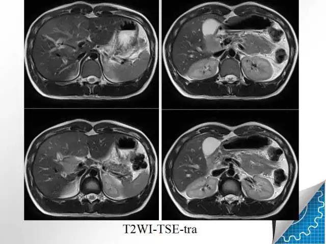 【病例学习】肝脏原发性恶性淋巴瘤一例CT MR影像表现