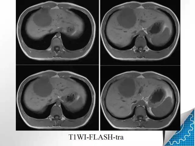 【病例学习】肝脏原发性恶性淋巴瘤一例CT MR影像表现