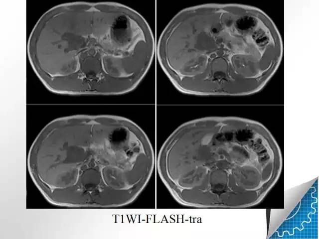 【病例学习】肝脏原发性恶性淋巴瘤一例CT MR影像表现