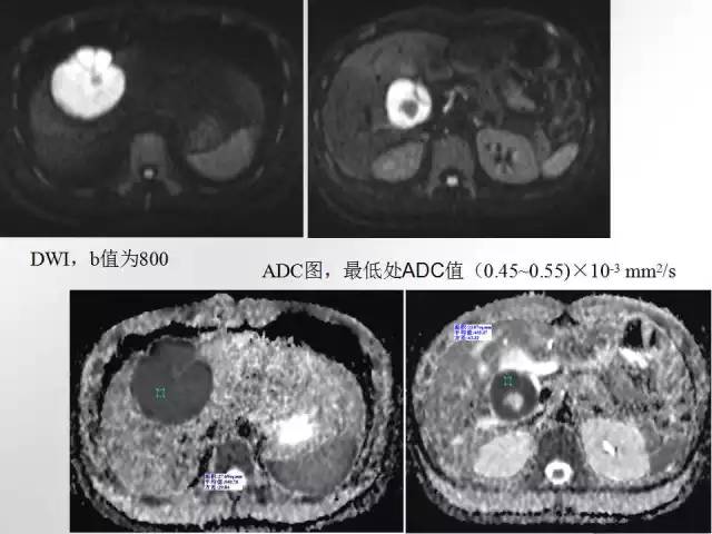 【病例学习】肝脏原发性恶性淋巴瘤一例CT MR影像表现
