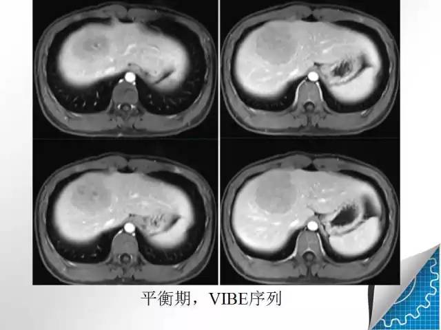 【病例学习】肝脏原发性恶性淋巴瘤一例CT MR影像表现