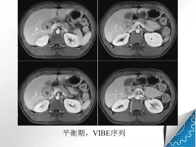 【病例学习】肝脏原发性恶性淋巴瘤一例CT MR影像表现