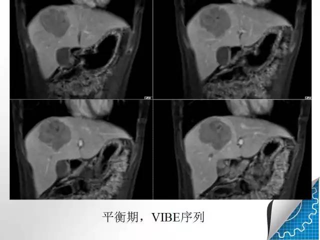 【病例学习】肝脏原发性恶性淋巴瘤一例CT MR影像表现