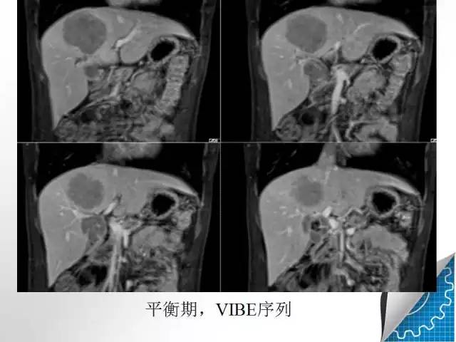 【病例学习】肝脏原发性恶性淋巴瘤一例CT MR影像表现