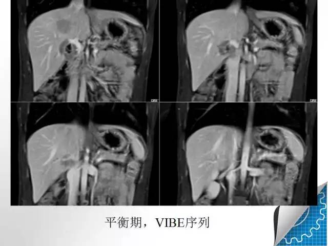 【病例学习】肝脏原发性恶性淋巴瘤一例CT MR影像表现
