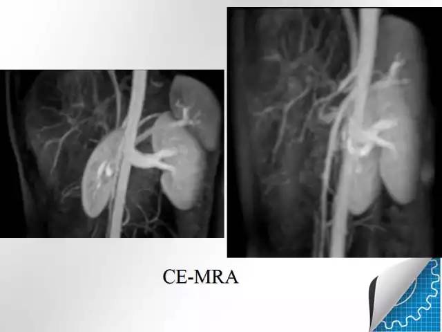 【病例学习】肝脏原发性恶性淋巴瘤一例CT MR影像表现
