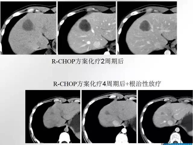 【病例学习】肝脏原发性恶性淋巴瘤一例CT MR影像表现