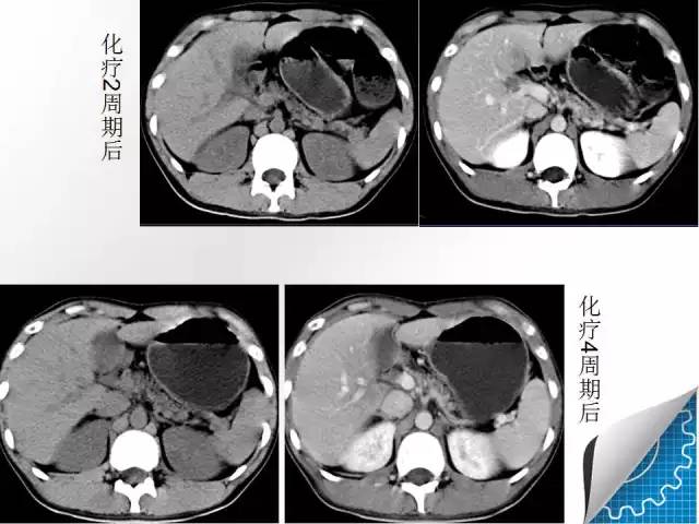 【病例学习】肝脏原发性恶性淋巴瘤一例CT MR影像表现