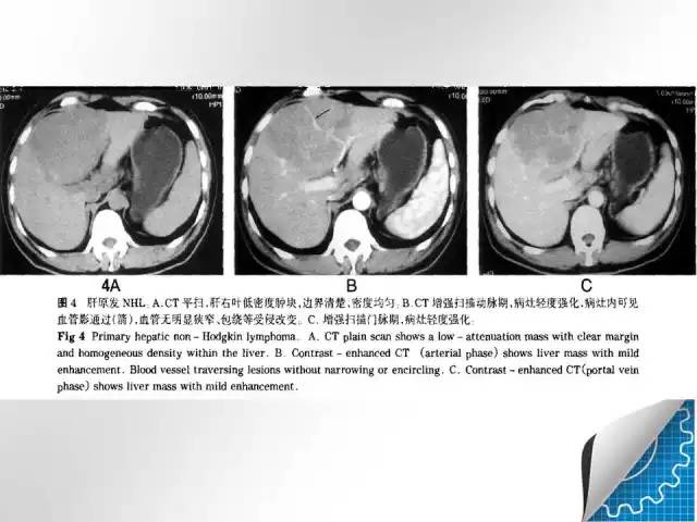 【病例学习】肝脏原发性恶性淋巴瘤一例CT MR影像表现