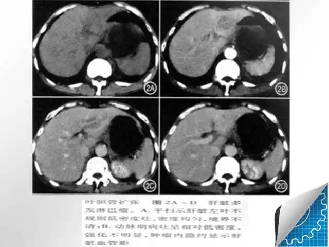 【病例学习】肝脏原发性恶性淋巴瘤一例CT MR影像表现