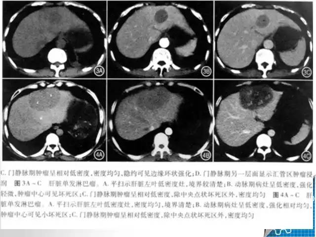 【病例学习】肝脏原发性恶性淋巴瘤一例CT MR影像表现