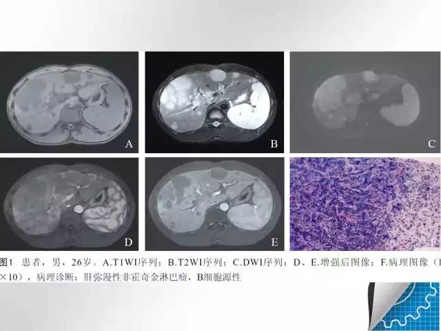 【病例学习】肝脏原发性恶性淋巴瘤一例CT MR影像表现