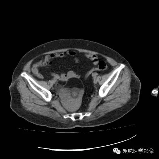 【病例学习】盆腔成熟畸胎瘤一例CT影像表现