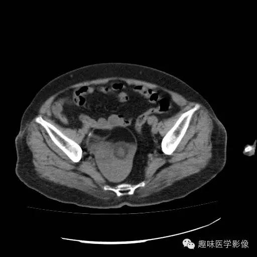 【病例学习】盆腔成熟畸胎瘤一例CT影像表现 【病例学习】盆腔成熟畸胎瘤一例CT影像表现