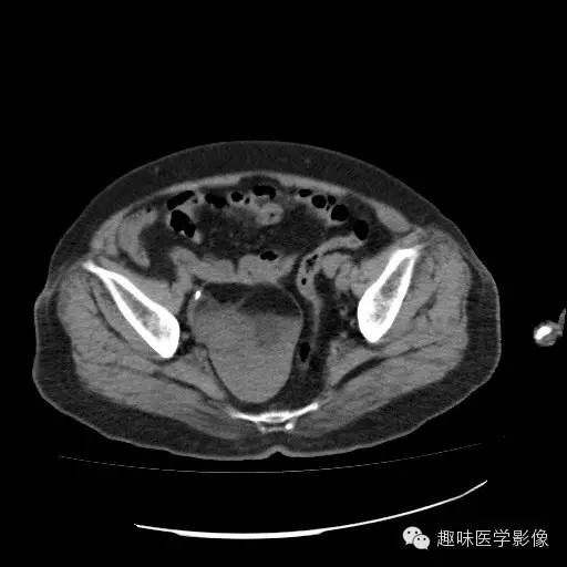 【病例学习】盆腔成熟畸胎瘤一例CT影像表现 【病例学习】盆腔成熟畸胎瘤一例CT影像表现