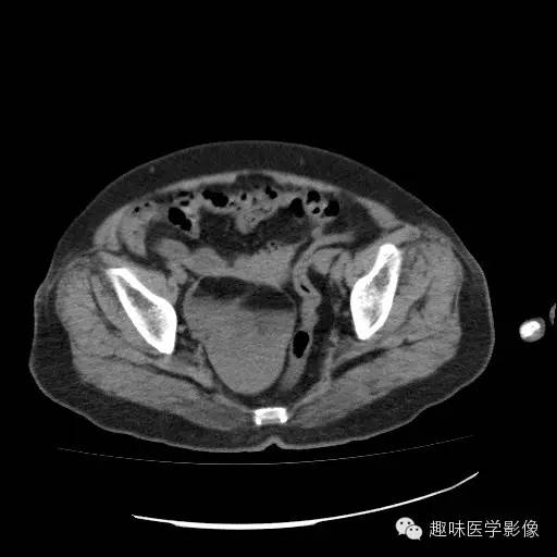 【病例学习】盆腔成熟畸胎瘤一例CT影像表现 【病例学习】盆腔成熟畸胎瘤一例CT影像表现