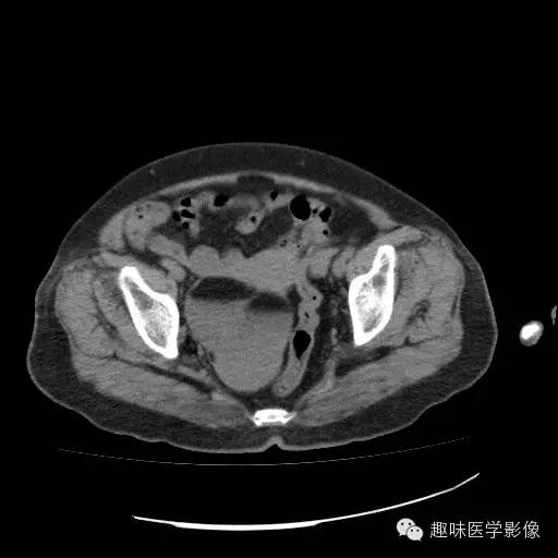 【病例学习】盆腔成熟畸胎瘤一例CT影像表现 【病例学习】盆腔成熟畸胎瘤一例CT影像表现