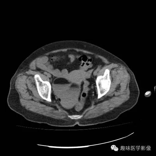 【病例学习】盆腔成熟畸胎瘤一例CT影像表现 【病例学习】盆腔成熟畸胎瘤一例CT影像表现