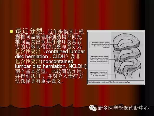 非包含性腰椎间盘突出的影像表现
