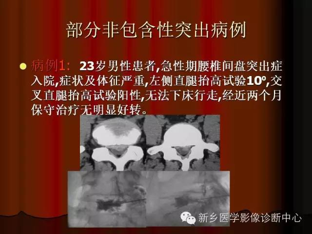 非包含性腰椎间盘突出的影像表现
