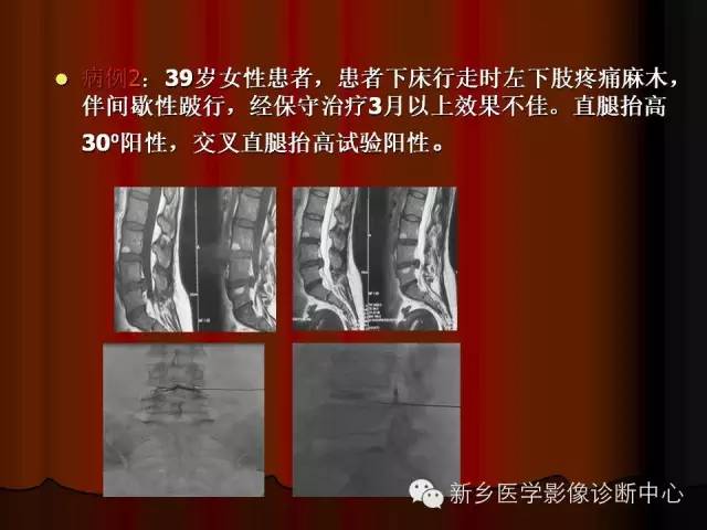 非包含性腰椎间盘突出的影像表现