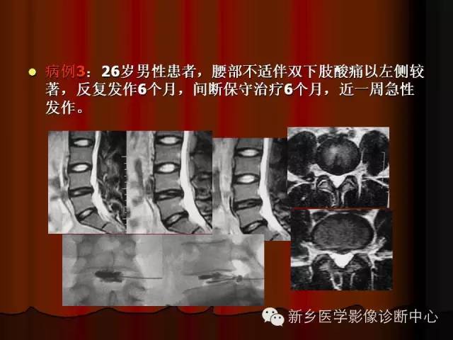 非包含性腰椎间盘突出的影像表现