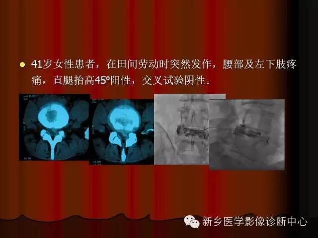 非包含性腰椎间盘突出的影像表现