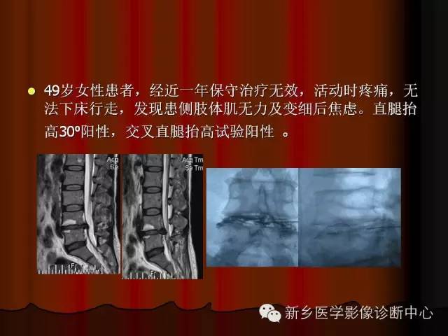 非包含性腰椎间盘突出的影像表现