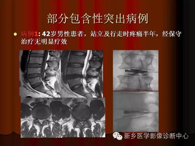 非包含性腰椎间盘突出的影像表现