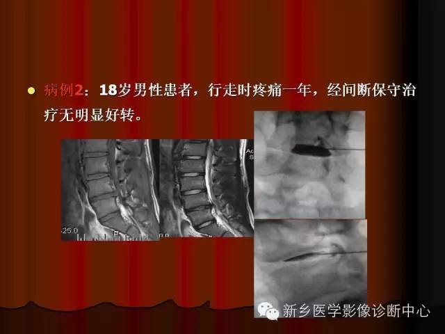 非包含性腰椎间盘突出的影像表现