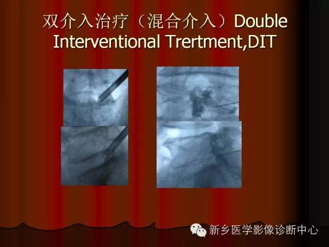非包含性腰椎间盘突出的影像表现