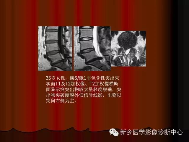 非包含性腰椎间盘突出的影像表现