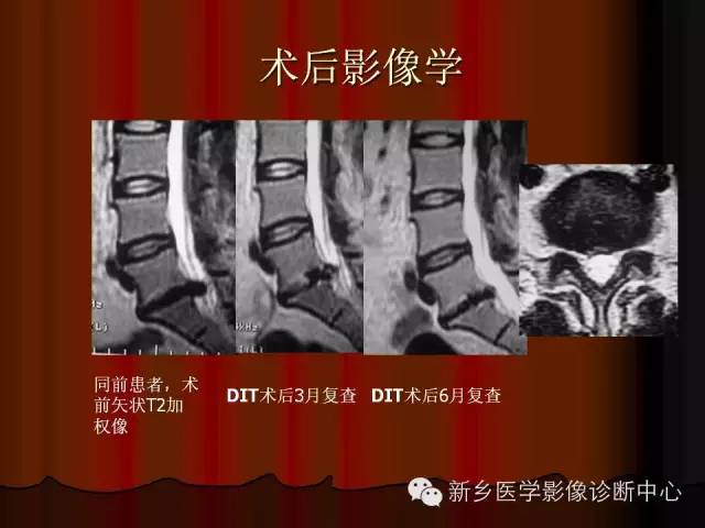非包含性腰椎间盘突出的影像表现
