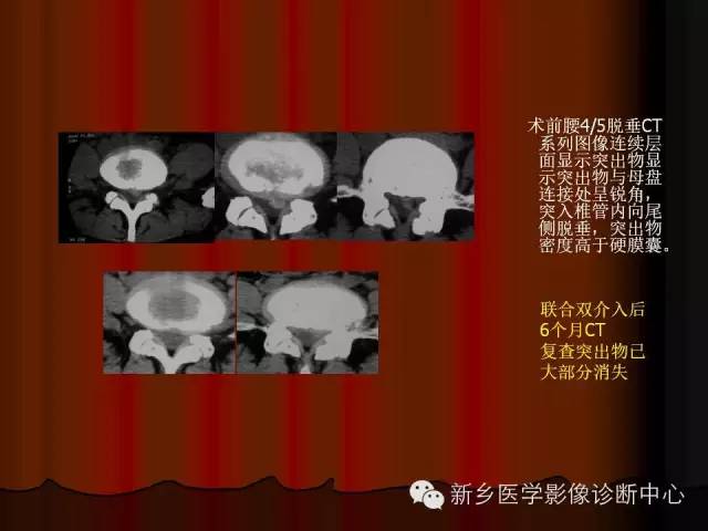 非包含性腰椎间盘突出的影像表现