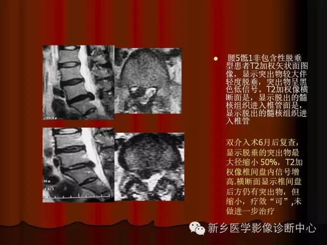 非包含性腰椎间盘突出的影像表现