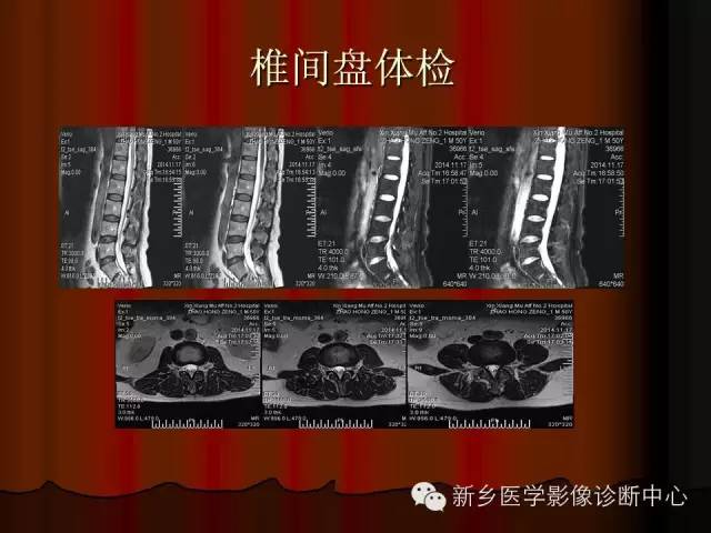 非包含性腰椎间盘突出的影像表现